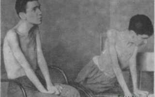 Спинальная мышечная атрофия Кугельберга-Веландера. Симптомы, диагностика, лечение