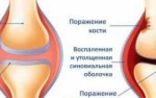 Лечение артрита, симптомы, признаки, причины, полный анализ заболевания