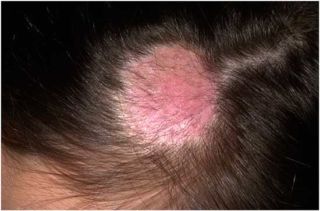 Стригущий лишай