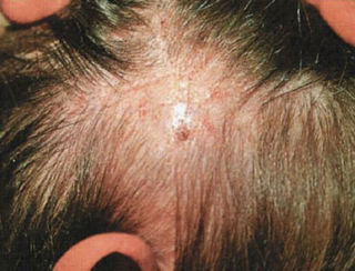 Узловатый лишай