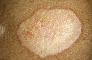 Белый лишай