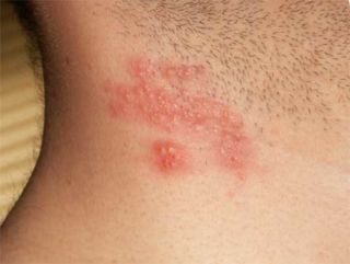 Кошачий лишай