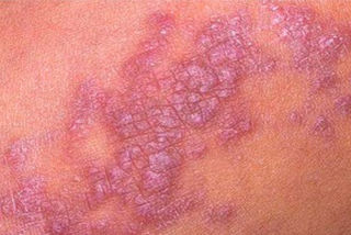 Красный плоский лишай