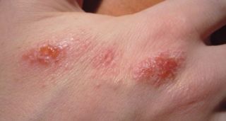 Мокнущий лишай