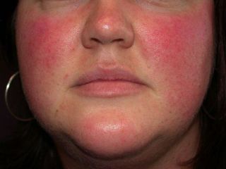 Покраснения на лице от Димексида