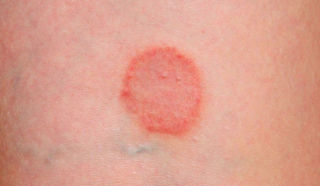 Розовый лишай