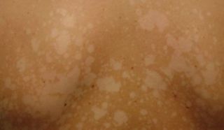 Солнечный лишай