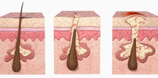 сальные железы