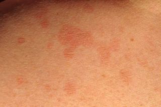 Трубчатый лишай