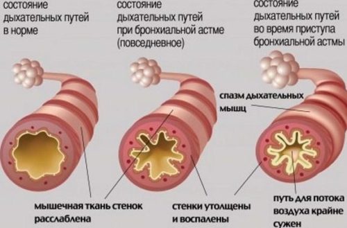 Степени бронхиальной астмы