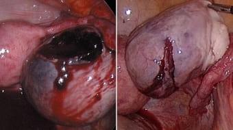 Жжение в яичниках при апоплексии кисты