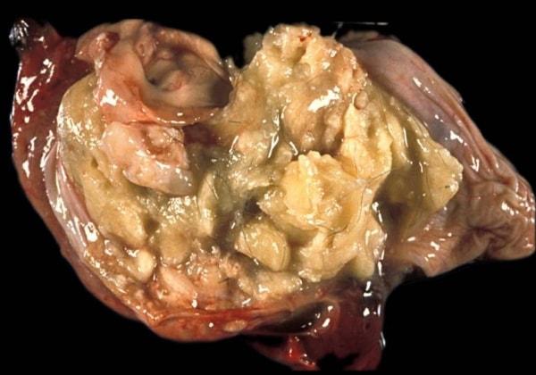 Фото дермоидной кисты после удаления