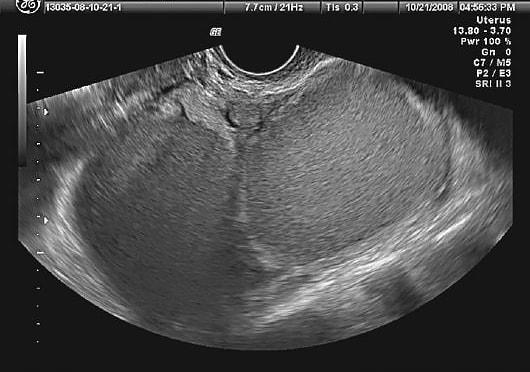 Проявление эндометриоза яичника на УЗИ