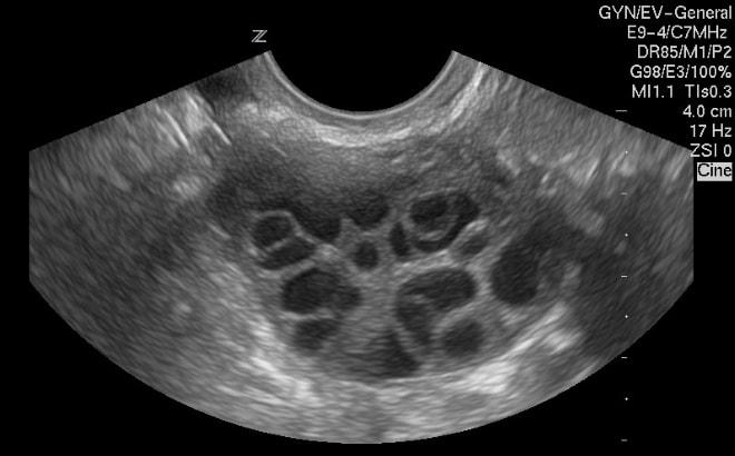 Результаты фолликулометрии