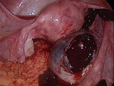 Апоплексия яичника на фото