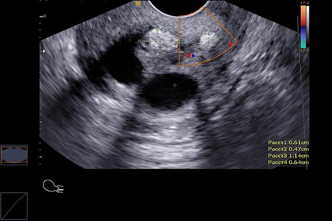 Как выглядят гиперэхогенные образования на УЗИ