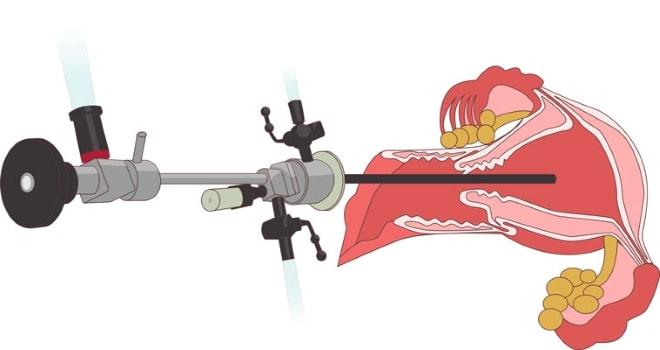 Как проводится гистероскопия