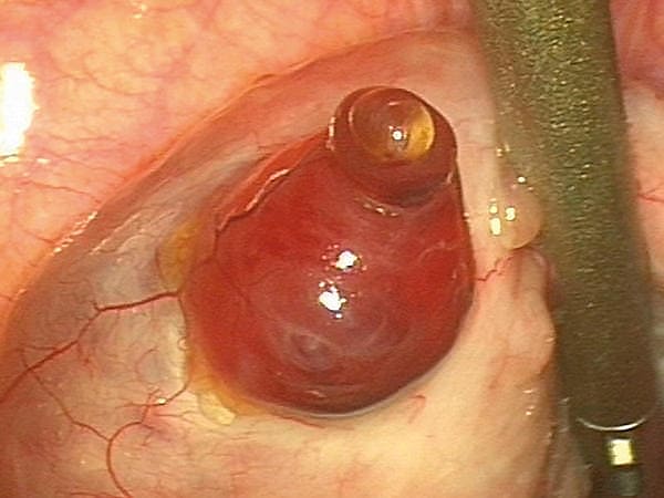 Доминантный фолликул у женщины