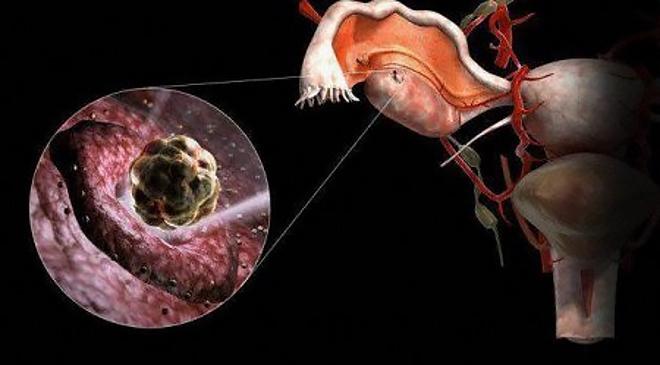 Поликистозный яичник у женщины на фото