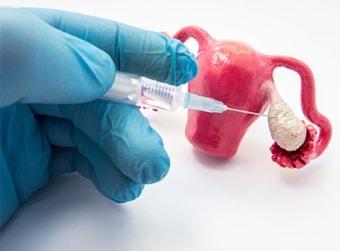 Стимулирование женских яичников