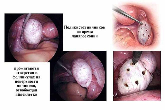 Лапароскопия при поликистозе