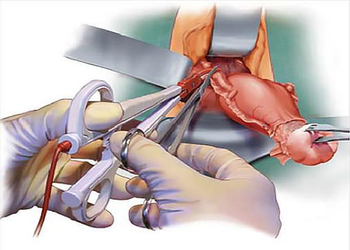 Процесс удаления матки