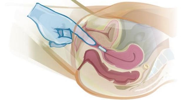 Введение вагинальных свечей
