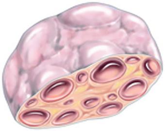 Фото в разрезе поликистозного яичника