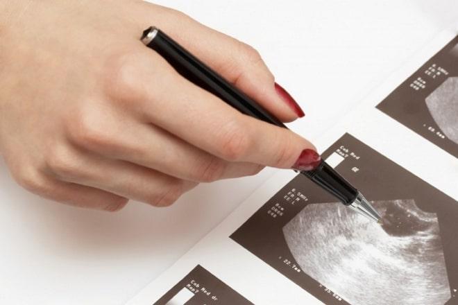 Врач выявил кисту желтого тела левого яичника при беременности