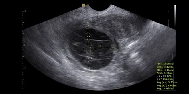 Как выглядит киста жёлтого тела на снимке УЗИ