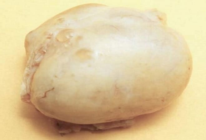 Кистома правого яичника