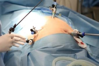 Как проводится классическая лапароскопия С какой целью проводится электрокаутеризация яичников