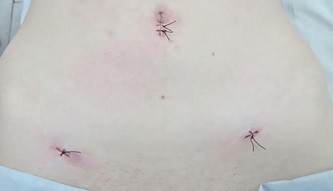 Снятие швов после лапароскопии яичника