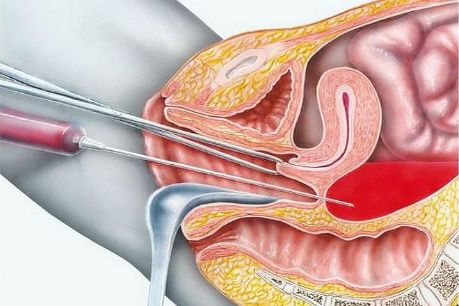 Проведение кульдоцентеза