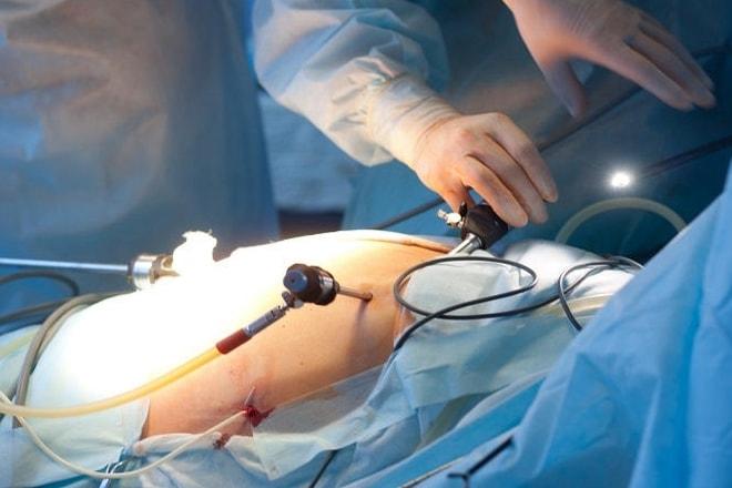 Лапароскопия при гидатиде яичника