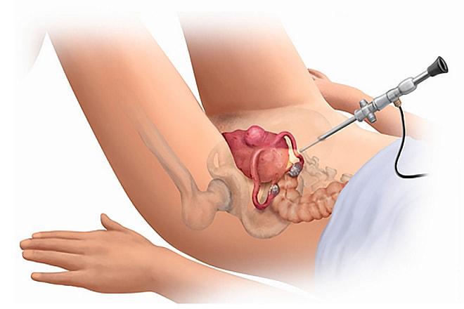 Проведение лапароскопии эндометриоидной кисты яичника