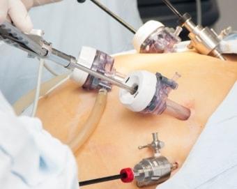 Проведение лапароскопии при беременности