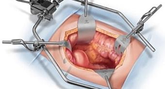 Как делается лапароскопия