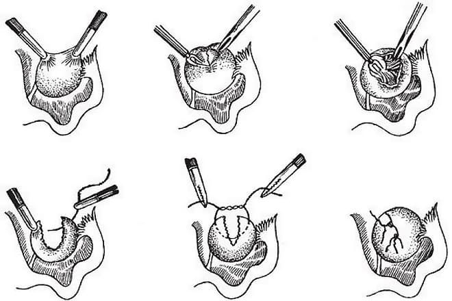 Процесс проведения лапаротомической цистэктомии