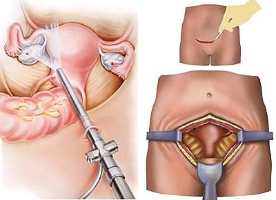 Хирургическое удаление эндометриоидной кисты яичника