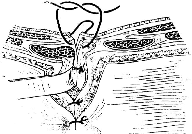 Трансректальная лапаротомия слева