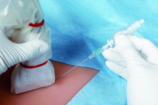 Как проводится биопсия яичника