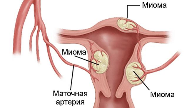 Где может располагаться миома матки