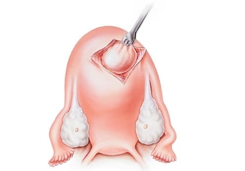 Миомэктомия в гинекологии