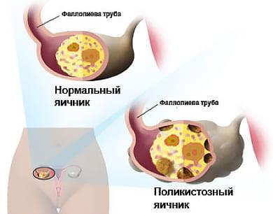 Мультифолликулярность яичника у женщины
