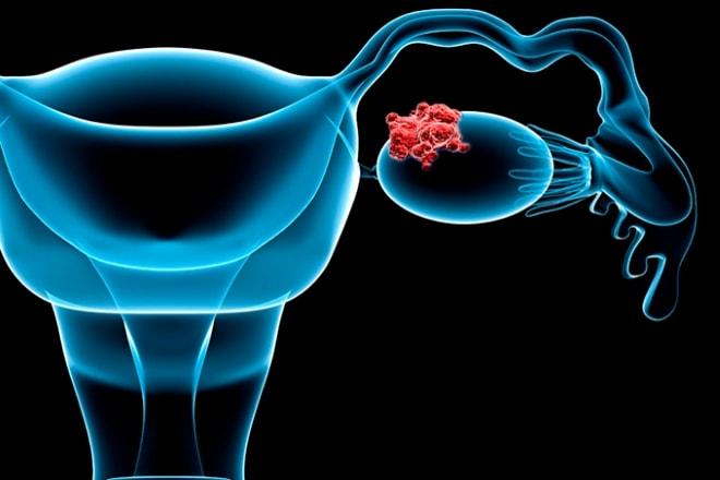 Раковая опухоль на яичнике женщины