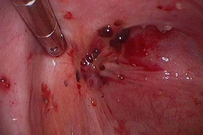 Фото образовавшегося эндометриоза