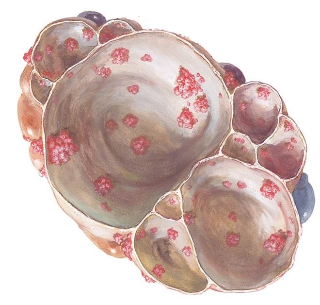 Папиллярная цистаденома