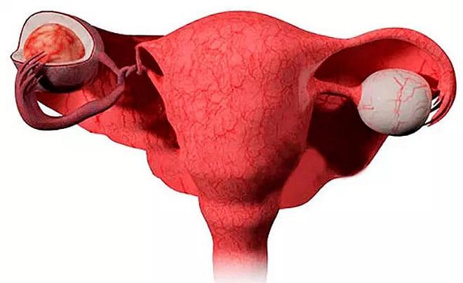 Ножка новообразования перекручена