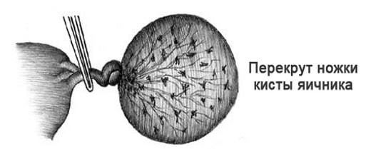 Рисунок перекрута ножки кисты яичника